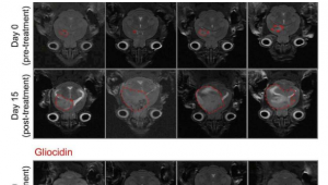 小鼠研究显示胶质母细胞瘤治疗前景光明